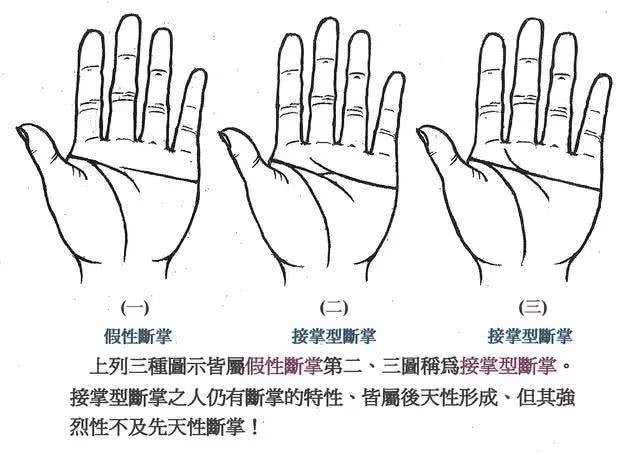 断掌的种类假型断掌和接掌型断掌